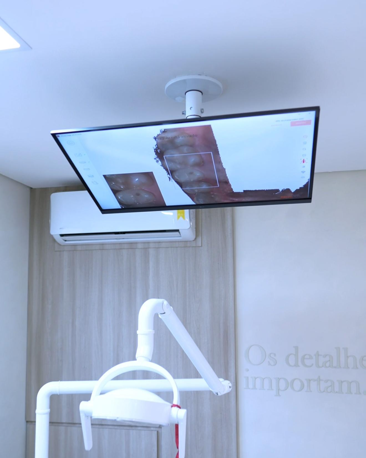 Scanner intraoral — os detalhes importam